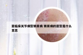 亞臨床關(guān)節(jié)病型銀屑病 銀屑病的亞型是什么意思