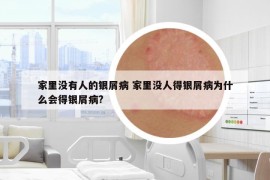 家里沒有人的銀屑病 家里沒人得銀屑病為什么會得銀屑病?