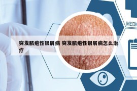 突發(fā)膿皰性銀屑病 突發(fā)膿皰性銀屑病怎么治療