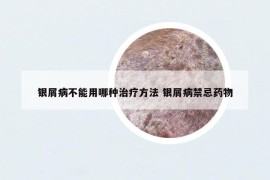 銀屑病不能用哪種治療方法 銀屑病禁忌藥物