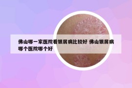 佛山哪一家醫(yī)院看銀屑病比較好 佛山銀屑病哪個醫(yī)院哪個好