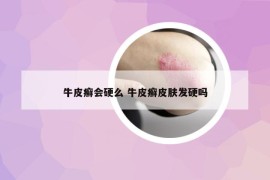 牛皮癬會(huì)硬么 牛皮癬皮膚發(fā)硬嗎
