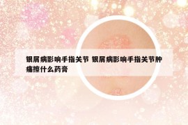 銀屑病影響手指關節(jié) 銀屑病影響手指關節(jié)腫痛擦什么藥膏
