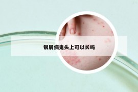 銀屑病鬼頭上可以長(zhǎng)嗎