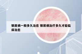 銀屑病一般多久治愈 銀屑病治療多久才能臨床治愈