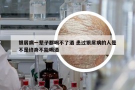 銀屑病一輩子都喝不了酒 患過(guò)銀屑病的人是不是終身不能喝酒