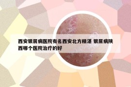 西安銀屑病醫(yī)院有名西安北方精湛 銀屑病陜西哪個醫(yī)院治療的好