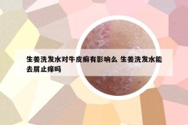 生姜洗發(fā)水對牛皮癬有影響么 生姜洗發(fā)水能去屑止癢嗎