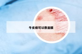 牛皮癬可以敷面膜
