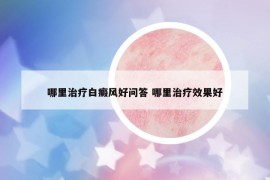 哪里治療白癜風(fēng)好問答 哪里治療效果好