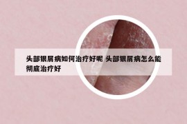 頭部銀屑病如何治療好呢 頭部銀屑病怎么能徹底治療好