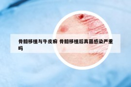 骨髓移植與牛皮癬 骨髓移植后真菌感染嚴(yán)重嗎