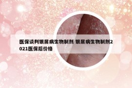 醫(yī)保談判銀屑病生物制劑 銀屑病生物制劑2021醫(yī)保后價格