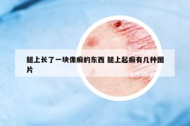 腿上長(zhǎng)了一塊像癬的東西 腿上起癬有幾種圖片