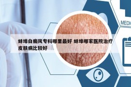 蚌埠白癜風?？颇睦镒詈?蚌埠哪家醫(yī)院治療皮膚病比較好