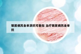 銀屑病蘇金單浪抗可善挺 治療銀屑病蘇金單抗
