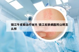 鎮(zhèn)江牛皮癬治療秘方 鎮(zhèn)江皮膚病醫(yī)院口碑怎么樣