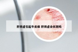 肝陰虛引起牛皮癬 肝陰虛會長斑嗎