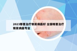 2023那里治療銀屑病最好 全國哪里治療銀屑病最專業(yè)