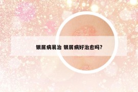 銀屑病易治 銀屑病好治愈嗎?