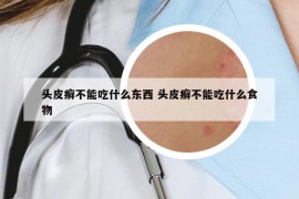 頭皮癬不能吃什么東西 頭皮癬不能吃什么食物