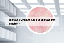 銀屑病吃了點(diǎn)海參湯會復(fù)發(fā)嗎 銀屑病患者能吃海參嗎?