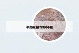 牛皮癬治好如何不犯