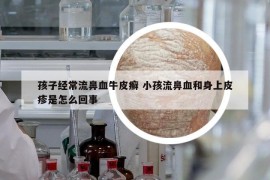 孩子經(jīng)常流鼻血牛皮癬 小孩流鼻血和身上皮疹是怎么回事