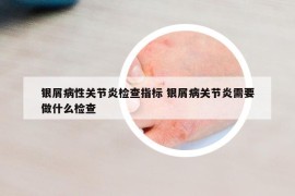 銀屑病性關(guān)節(jié)炎檢查指標(biāo) 銀屑病關(guān)節(jié)炎需要做什么檢查