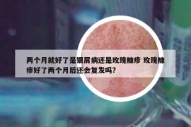 兩個月就好了是銀屑病還是玫瑰糠疹 玫瑰糠疹好了兩個月后還會復(fù)發(fā)嗎?