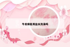 牛皮癬能用鹽水洗澡嗎