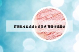 苔蘚性皮炎誤診為銀屑病 苔蘚樣銀屑病