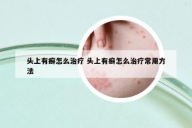 頭上有癬怎么治療 頭上有癬怎么治療常用方法