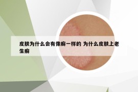 皮膚為什么會(huì)有像癬一樣的 為什么皮膚上老生癬
