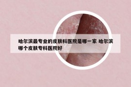 哈爾濱最專業(yè)的皮膚科醫(yī)院是哪一家 哈爾濱哪個皮膚?？漆t(yī)院好