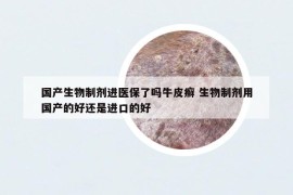 國產(chǎn)生物制劑進(jìn)醫(yī)保了嗎牛皮癬 生物制劑用國產(chǎn)的好還是進(jìn)口的好