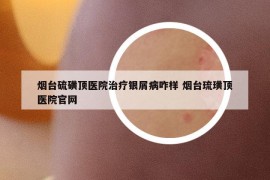 煙臺硫磺頂醫(yī)院治療銀屑病咋樣 煙臺琉璜頂醫(yī)院官網(wǎng)
