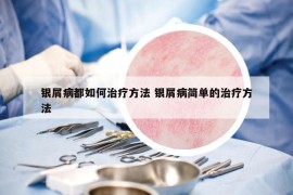 銀屑病都如何治療方法 銀屑病簡單的治療方法