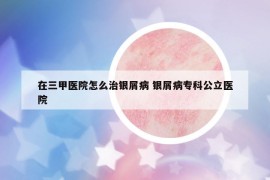 在三甲醫(yī)院怎么治銀屑病 銀屑病?？乒⑨t(yī)院