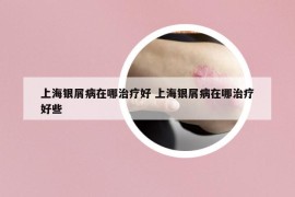 上海銀屑病在哪治療好 上海銀屑病在哪治療好些