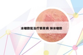冰硼散能治療銀屑病 抹冰硼散