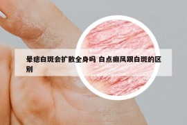 暈痣白斑會擴散全身嗎 白點癲風跟白斑的區(qū)別