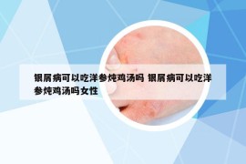 銀屑病可以吃洋參燉雞湯嗎 銀屑病可以吃洋參燉雞湯嗎女性