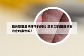 膿包型銀屑病懷孕的風(fēng)險 膿包型的銀屑病有治愈的案例嗎?