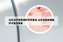 山東治療銀屑病的專家是誰 山東治銀屑病最好中醫(yī)在哪里
