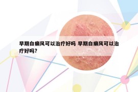 早期白癩風(fēng)可以治療好嗎 早期白癩風(fēng)可以治療好嗎?