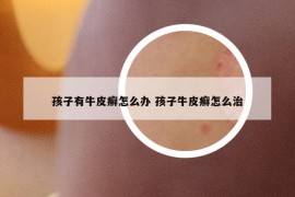 孩子有牛皮癬怎么辦 孩子牛皮癬怎么治