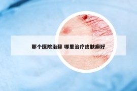 那個醫(yī)院治蘚 哪里治療皮膚癬好