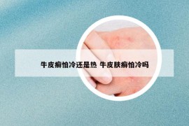 牛皮癬怕冷還是熱 牛皮膚癬怕冷嗎