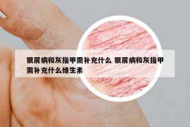銀屑病和灰指甲需補(bǔ)充什么 銀屑病和灰指甲需補(bǔ)充什么維生素